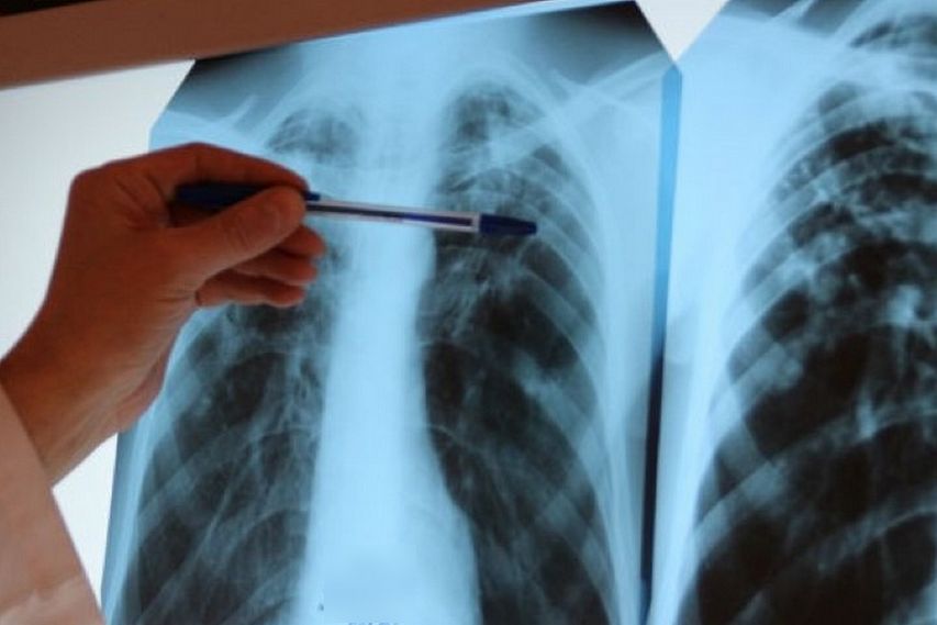 Прокуратура разъясняет порядок принудительной госпитализации больного туберкулёзом